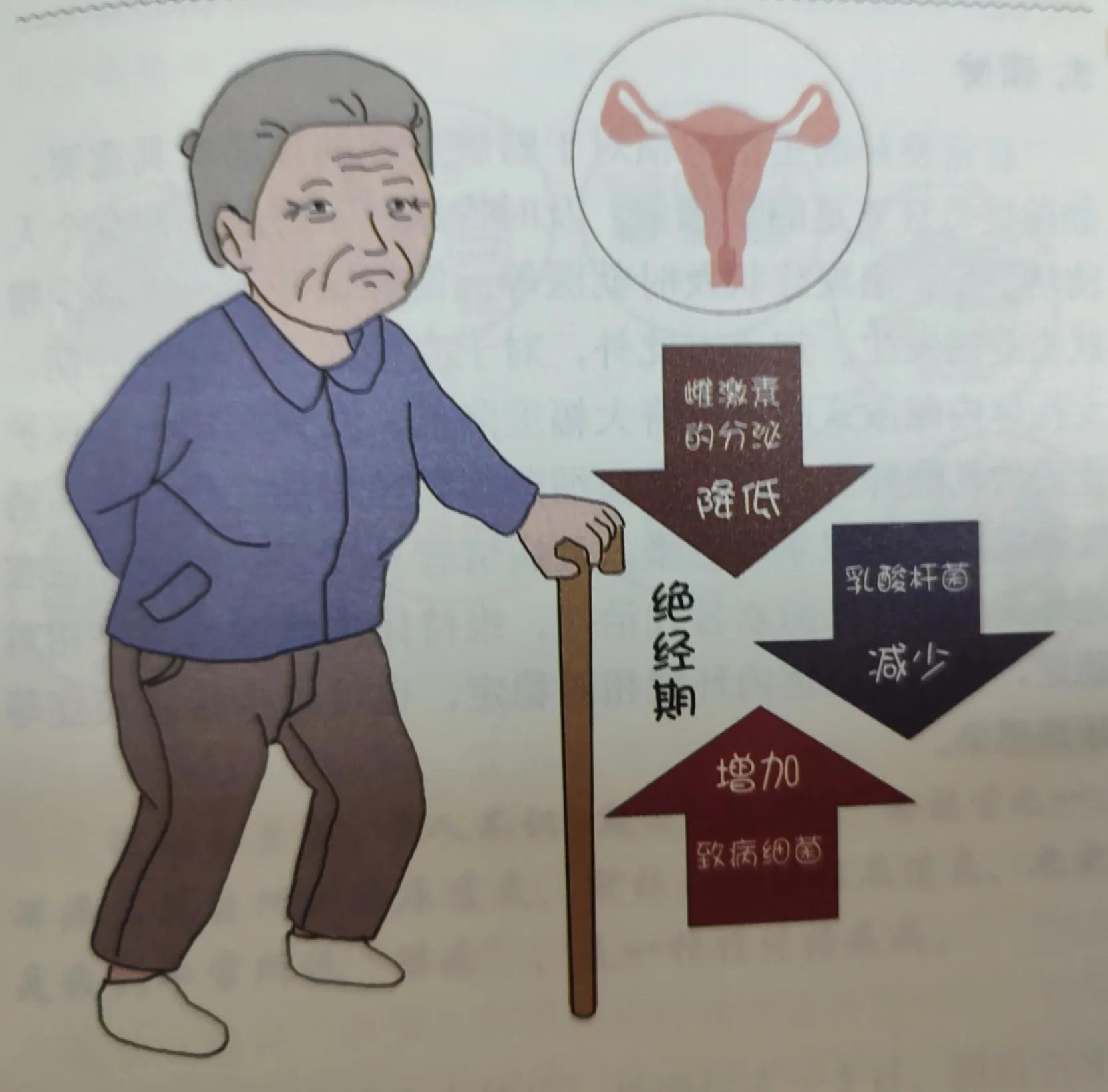 泌尿感染膀胱炎怎么治疗,急性尿路感染膀胱炎是如何引起的