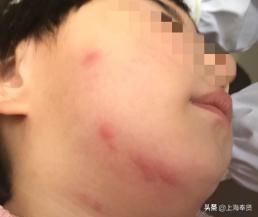 夏天虫咬皮炎的治疗方法,虫咬性皮炎到底如何杀虫