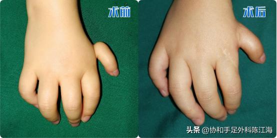 宝宝拇指有两个，都悬挂不能动，父母四处求医，只为还原孩子五指