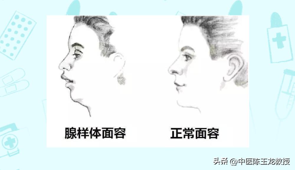 小儿腺样体肥大中医最佳治疗方法,老中医看儿童腺样体肥大怎么治疗