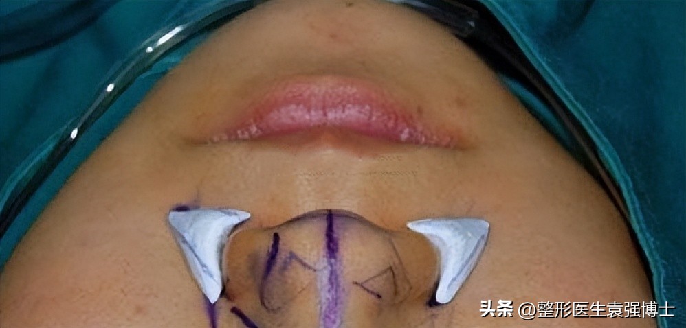 法令纹难去除，多是没弄清成因，医生教你几招实用的方法