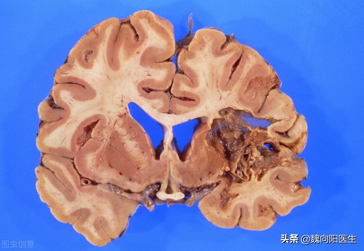 脑出血病人急救黄金30秒,脑血栓免费康复训练