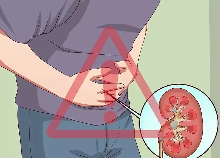 肾结石疼到怀疑人生的图片,肾结石科普一下