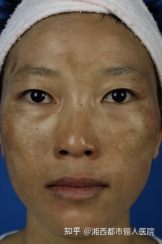 褐斑怎么去除才可以清除掉,褐斑怎样才能彻底的去掉