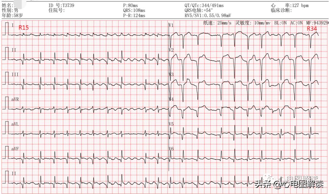 心房颤动三大临床表现,心房颤动的症状视频