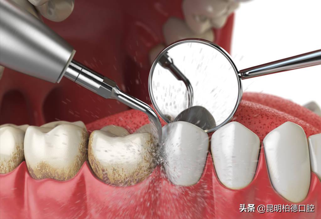 洗牙喷砂和龈下刮治的区别,洗牙套餐里喷砂是什么意思