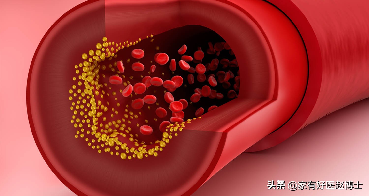 影响胆固醇的高低哪六项重要因素,胆固醇偏高的危害和预防