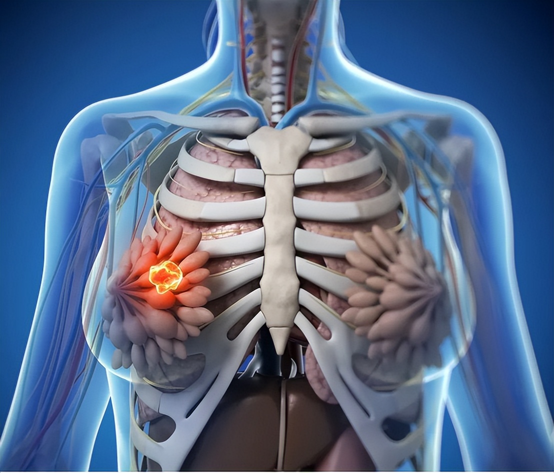 异时性双侧原发性乳腺癌10年,双侧原发性乳腺癌需要化疗吗