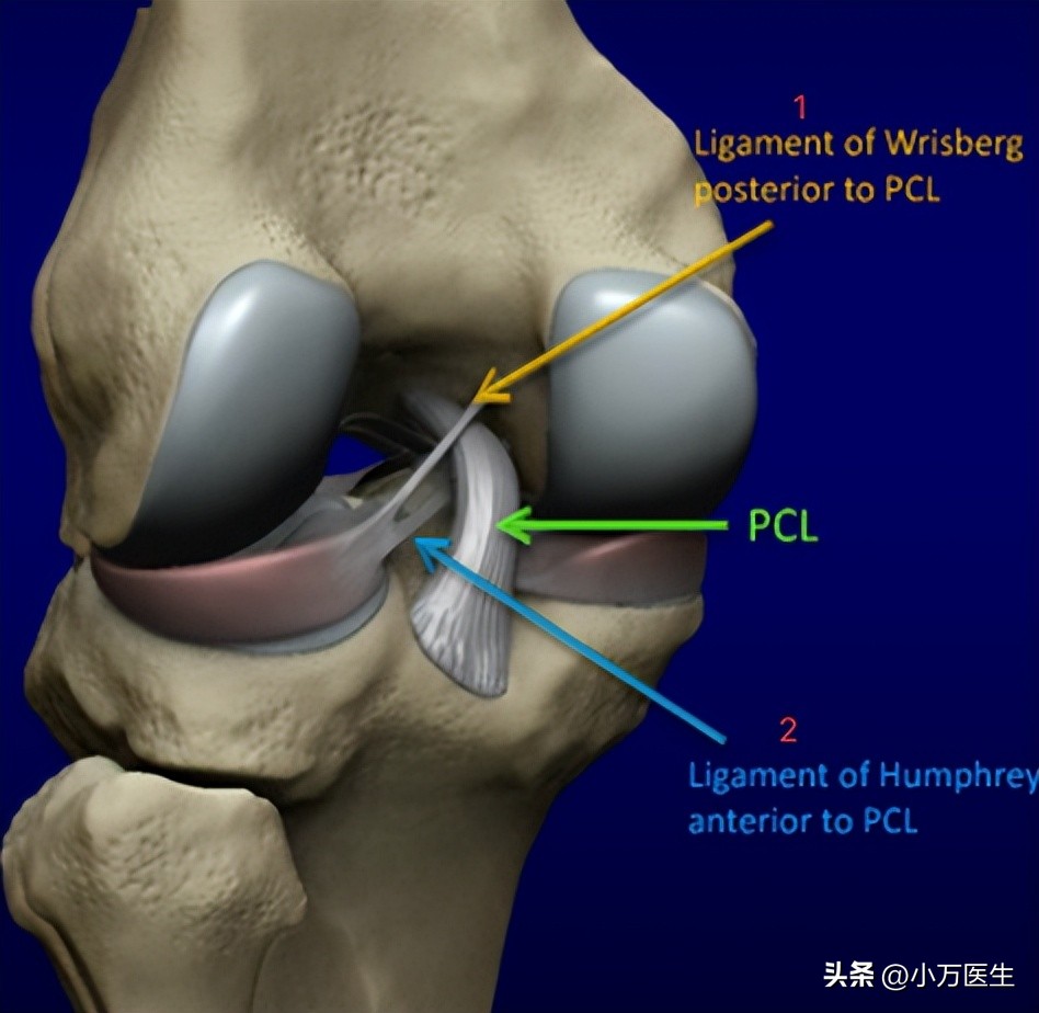 半月板撕裂如何鉴别级数,半月板撕裂分型
