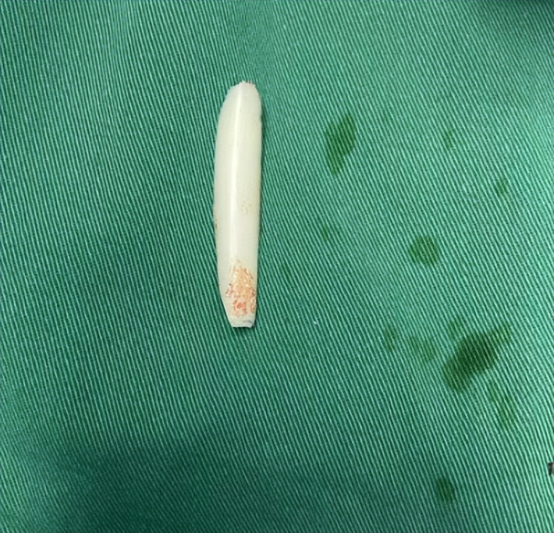 10年隆鼻假体取出后恢复图片,10年鼻假体取出会肿几天