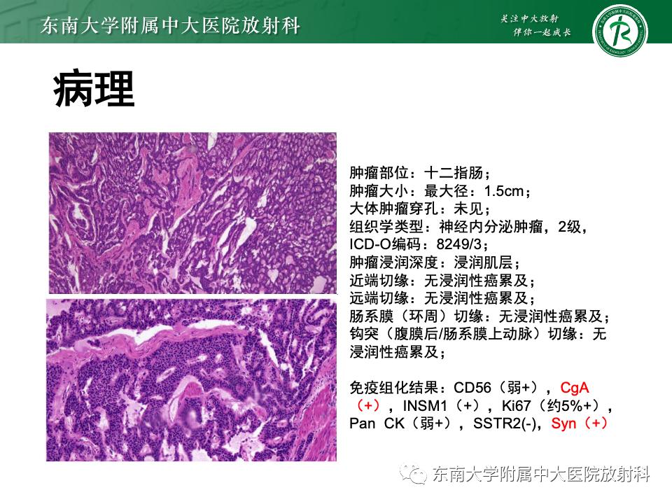 小肠间质瘤最新治疗中药方,小肠间质瘤基因检测