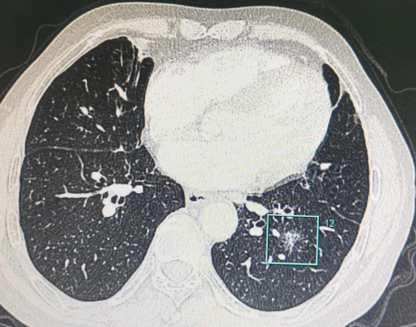 磨玻璃结节胸外科医生说要手术,体检查出4mm磨玻璃结节需要动手术
