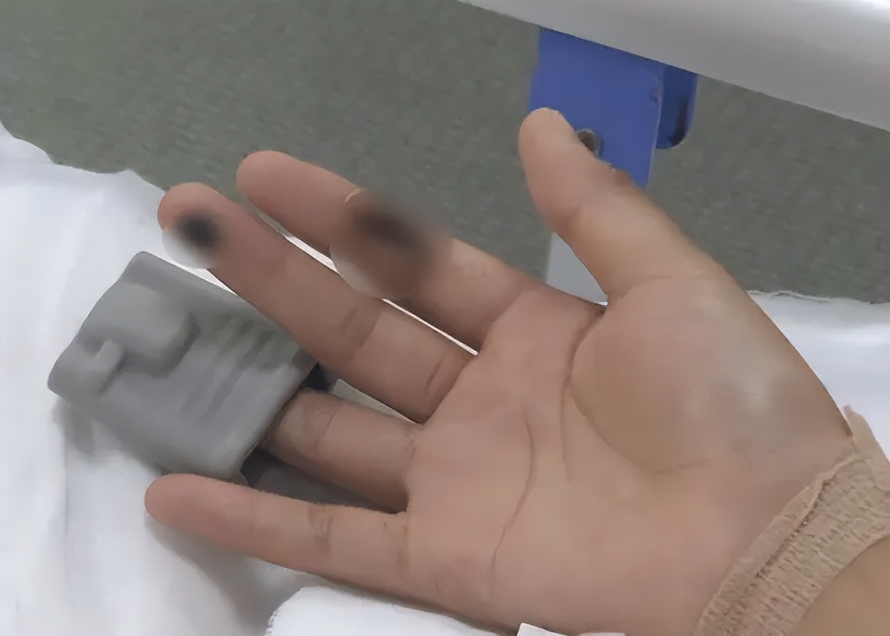 女孩iphone充电被电击面临截肢,iphone边充边玩被电击