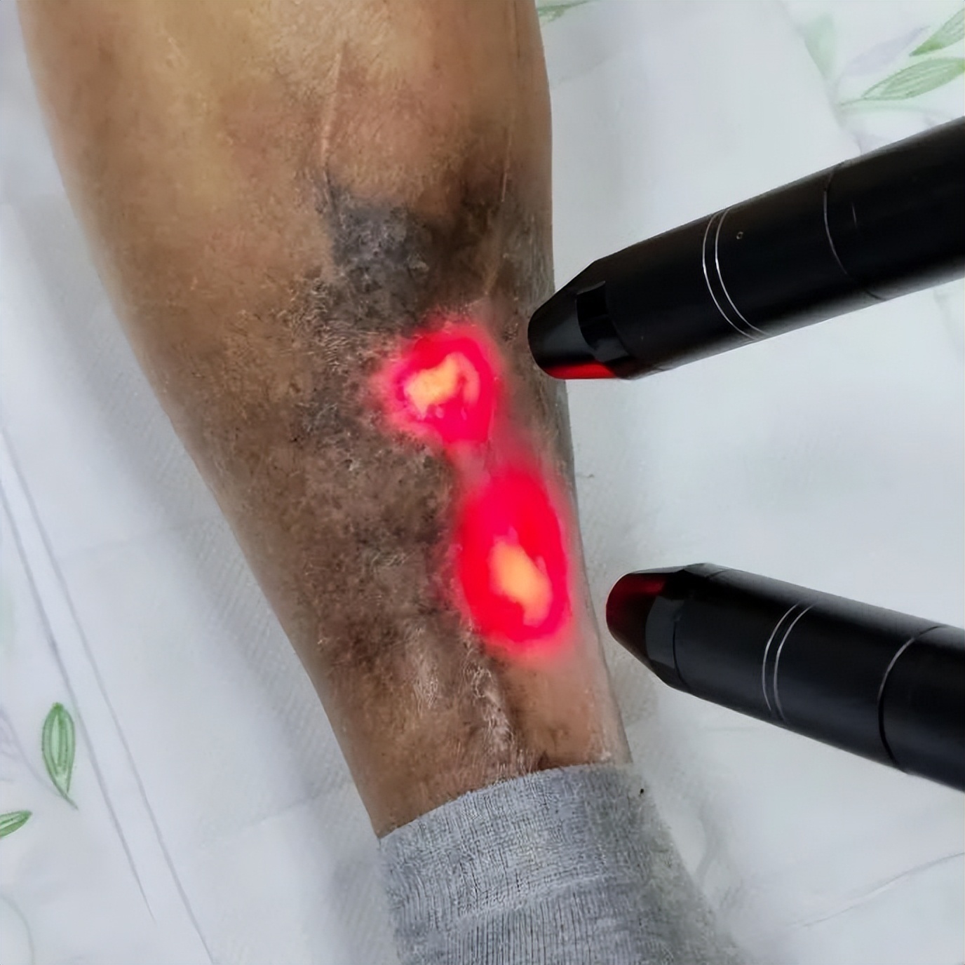 多科室合作救治,多管齐下抗击病魔