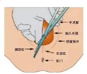 顺产如何防止侧切和撕裂,顺产妈妈最怕什么