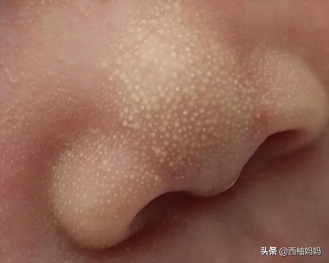 有湿疹的宝宝过敏是什么样的,宝宝过敏引起的湿疹需要去医院吗