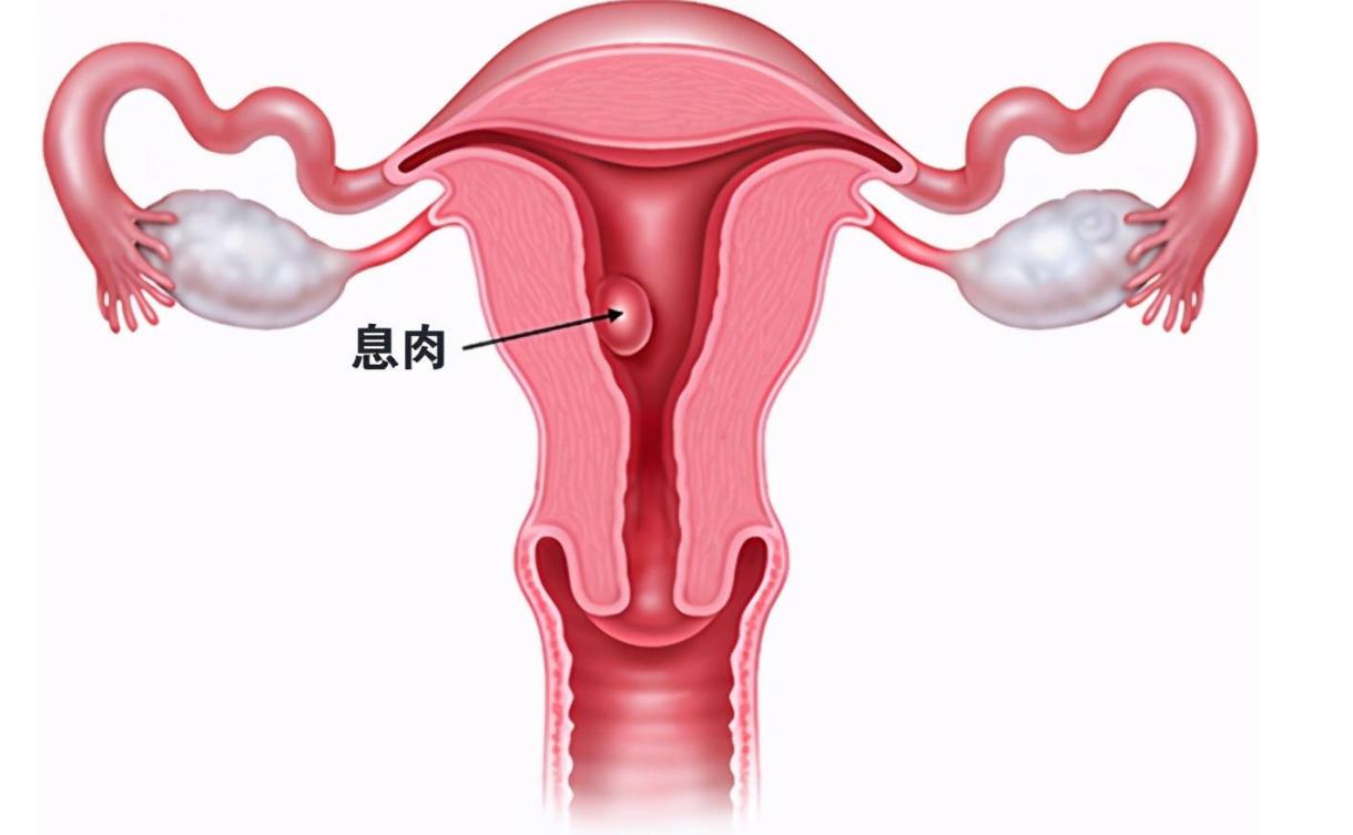 子宫息肉切除了复发要多久,子宫息肉切除后复发怎么办