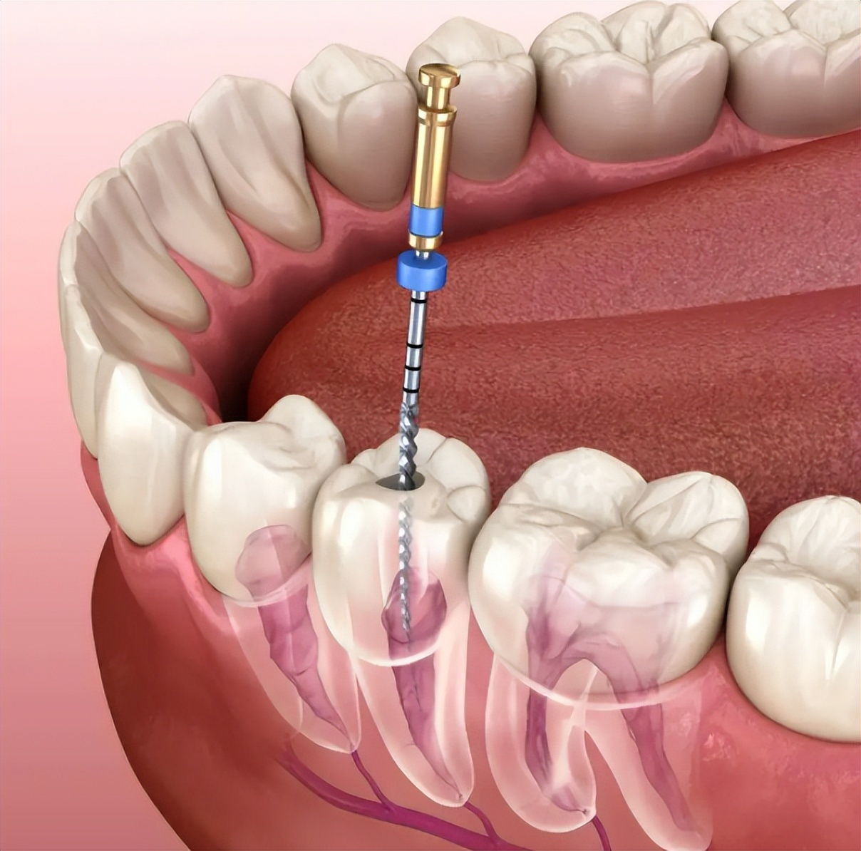 根管治疗后牙齿劈了,到底是谁的锅?专家:别把建议当回事儿