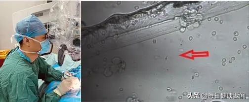 无精症突然又有精子,无精睾丸超声能查出什么问题