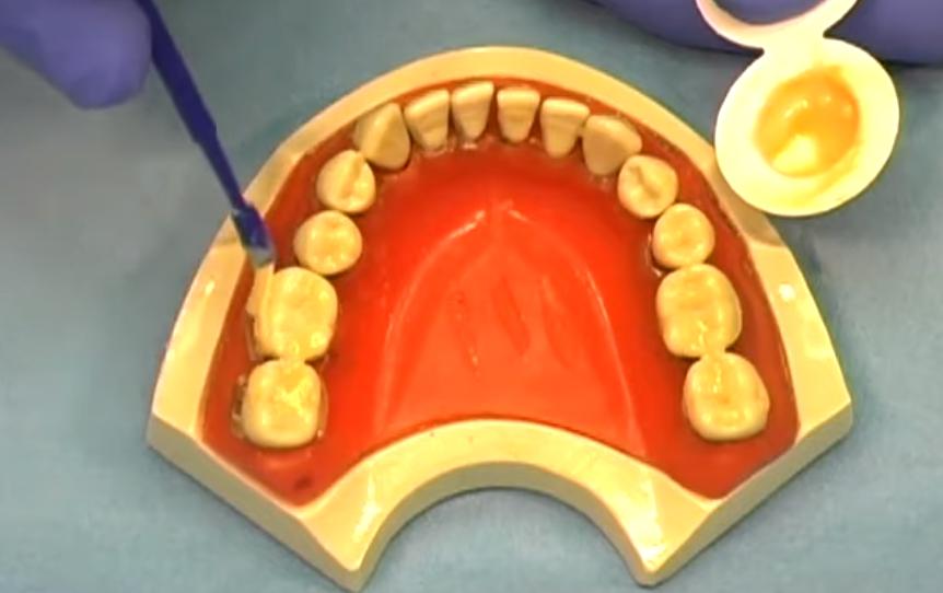 牙齿已经蛀牙了还能涂氟吗,儿童蛀牙了还可以涂氟吗