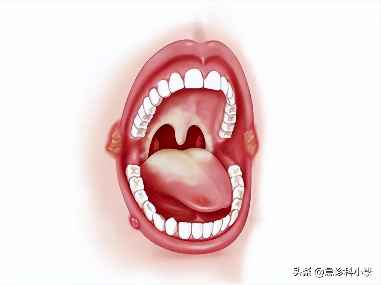 口腔癌有什么症状怎么预防,口腔癌的症状及如何预防