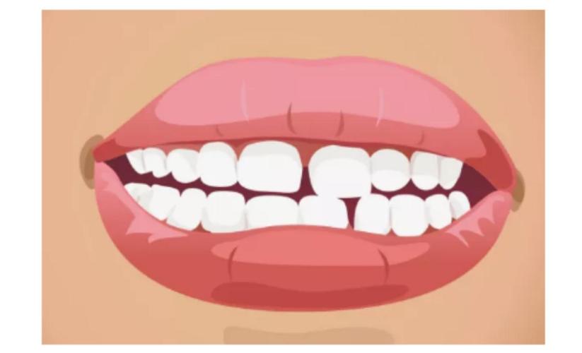 牙缝大怎么补,牙缝大可不可以修补