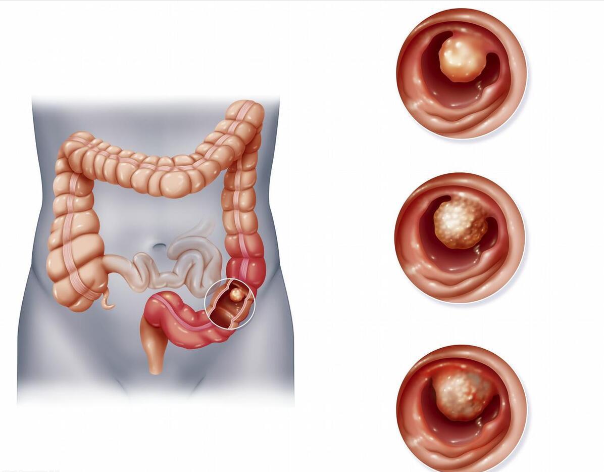 结直肠癌一般发病年龄,结直肠癌的诱因及病因