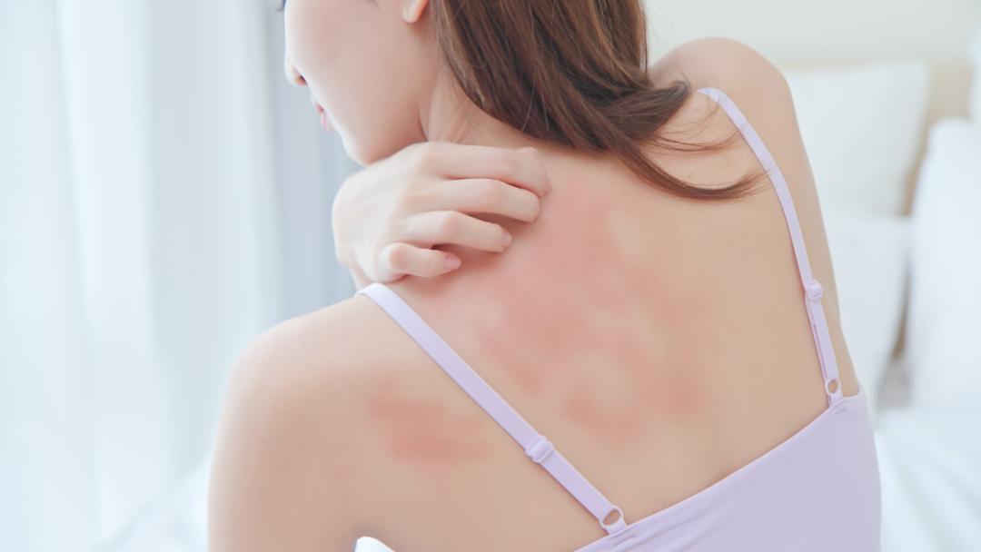 过敏体质反反复复的过敏该怎么办,过敏反复肌肤怎么修复