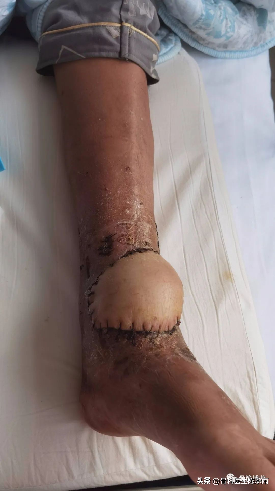 娓哥鐨摚淇,涔旀皬鐨摚淇瓒宠儗澶栦晶鐨偆缂烘崯