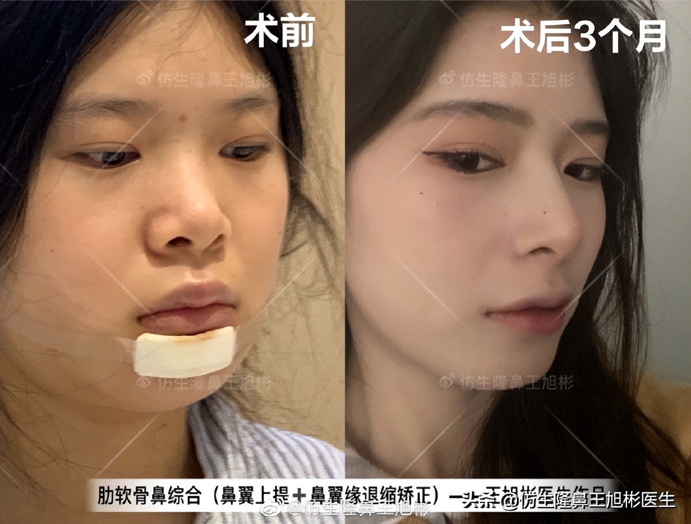 鼻翼缘退缩要如何矫正|王旭彬隆鼻