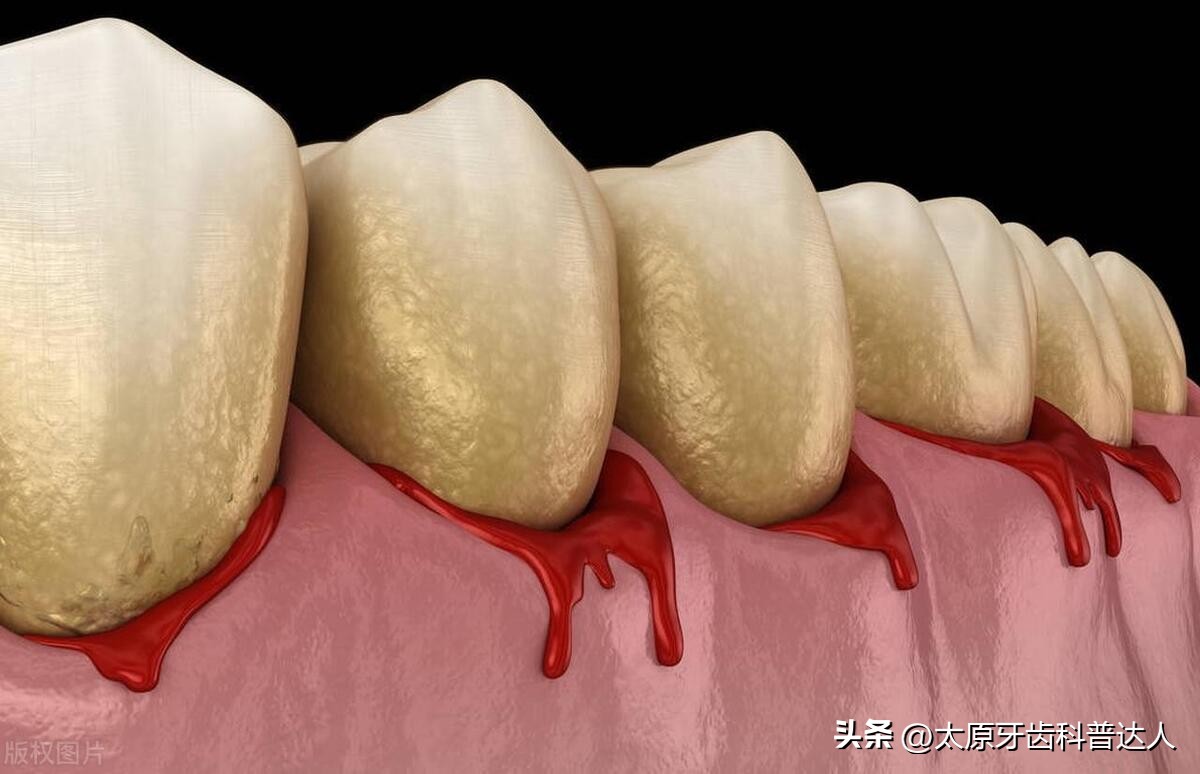牙龈炎牙周炎相关知识,牙龈炎牙周炎保健知识科普