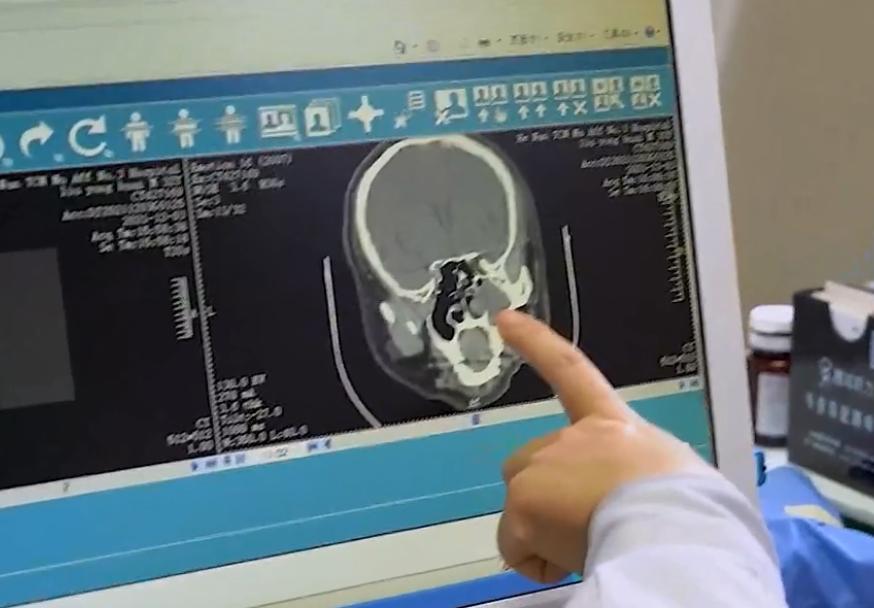 过敏性鼻炎中医上讲是怎么引起的,鼻炎的常见种类及六个小妙招