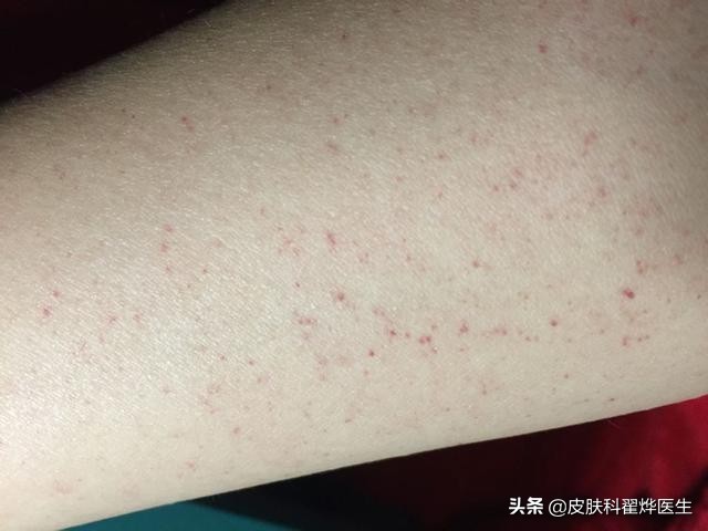 中老年人身上长红痣怎么回事,身上长了红痣到医院挂哪个科检查