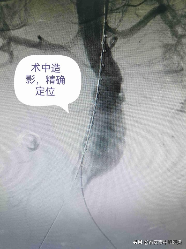 【创新技术】*安泰**市中医医院介入诊疗科：精准影像介入治疗，排除腹主动脉“不定时*弹炸**”