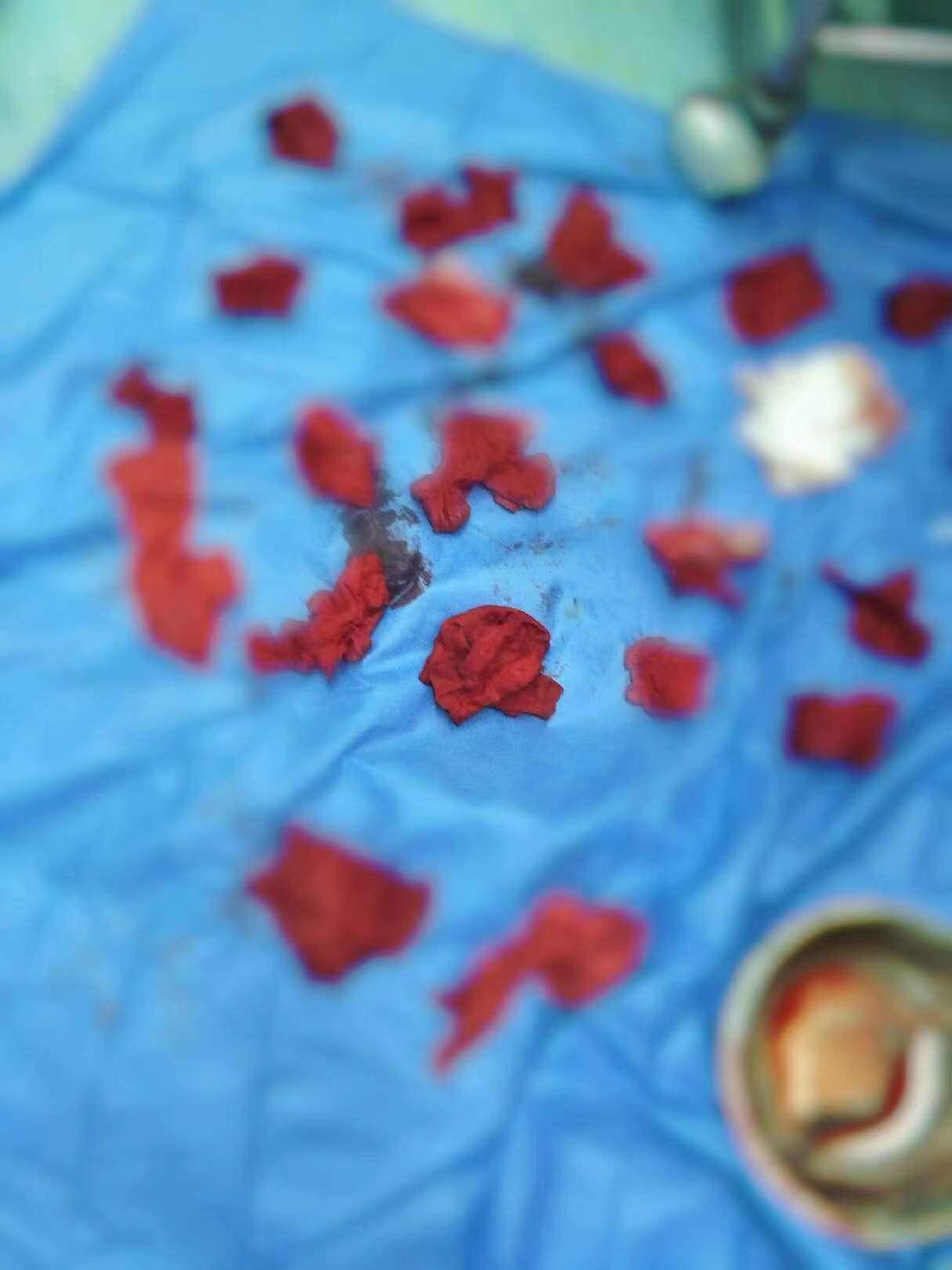 杭州少女大出血,杭州25岁女孩突然大出血