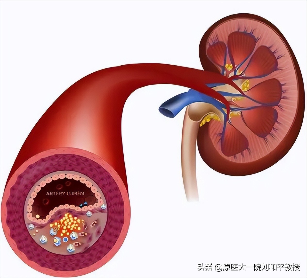 肾动脉狭窄患者介入治疗有危险吗,攻克高血压心脏病最新疗法