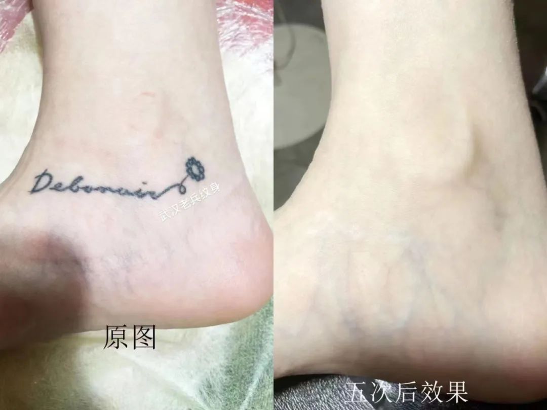 洗纹身最好的方法不留疤不留痕迹,洗纹身最好的方法不留疤不留印