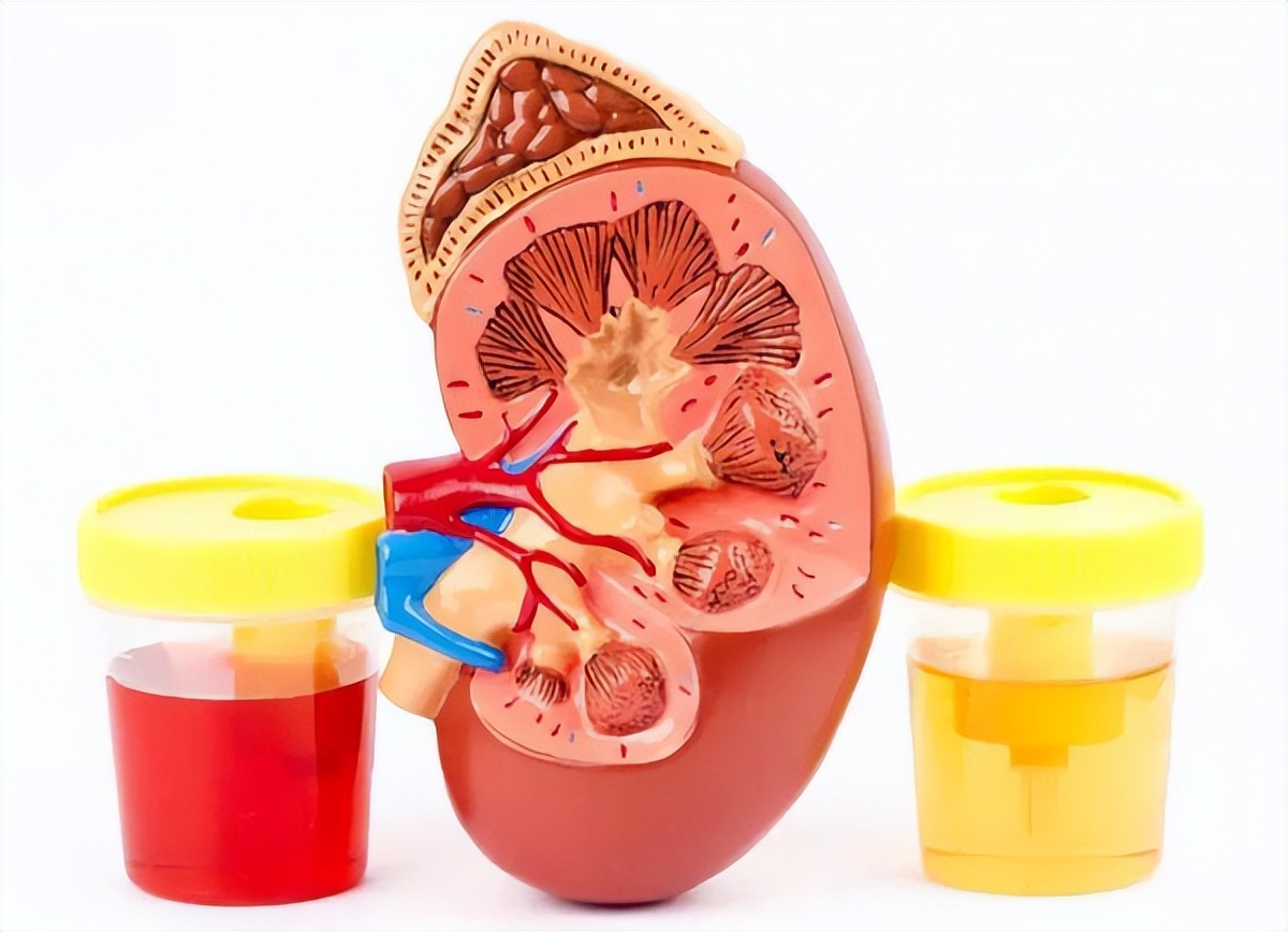 治疗iga肾病常见的注意事项有哪些,iga肾病复发怎么保养恢复过来