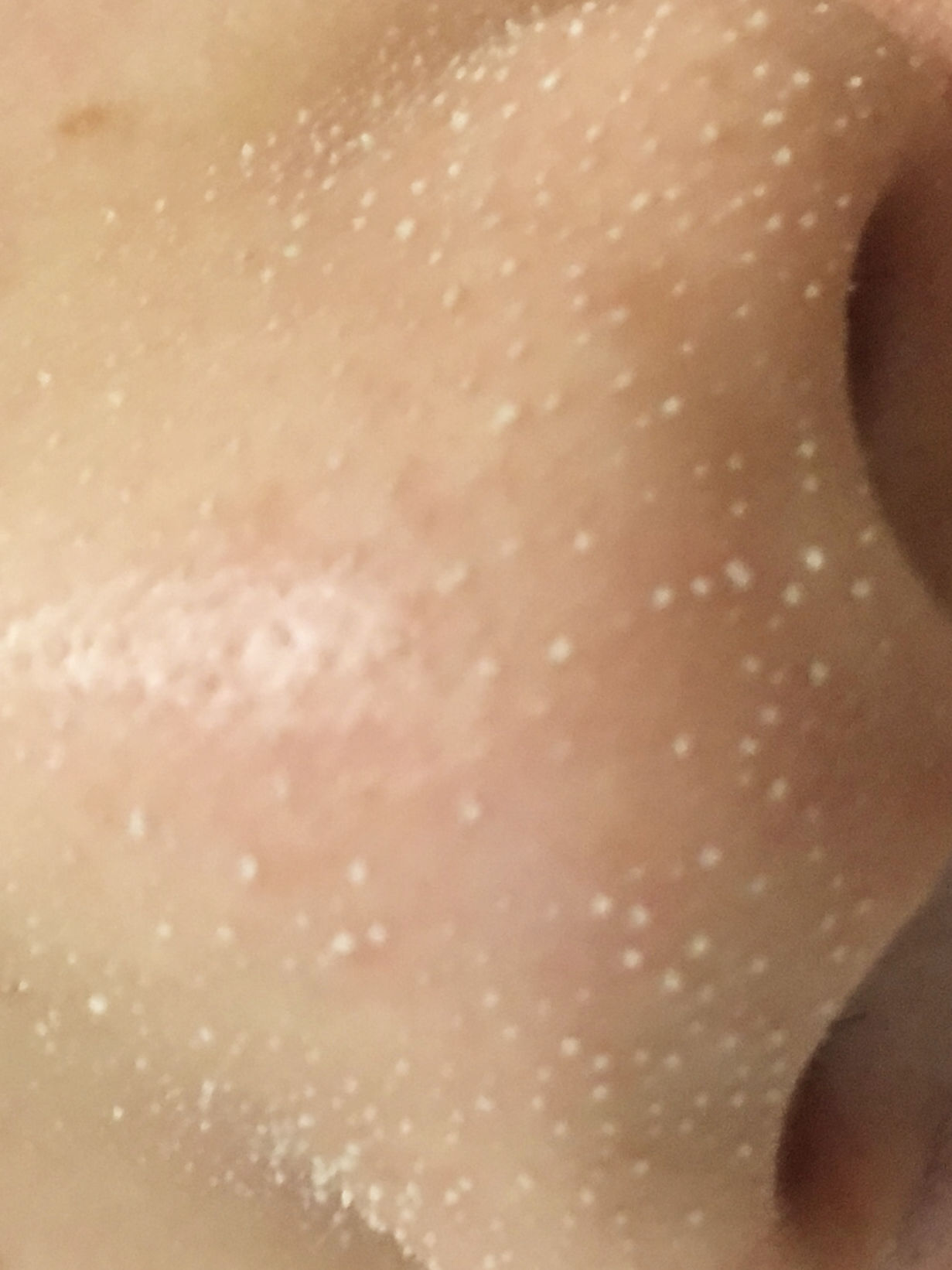 毛孔堵塞怎样才能疏通毛孔,身上毛孔堵塞不出汗怎么疏通毛孔