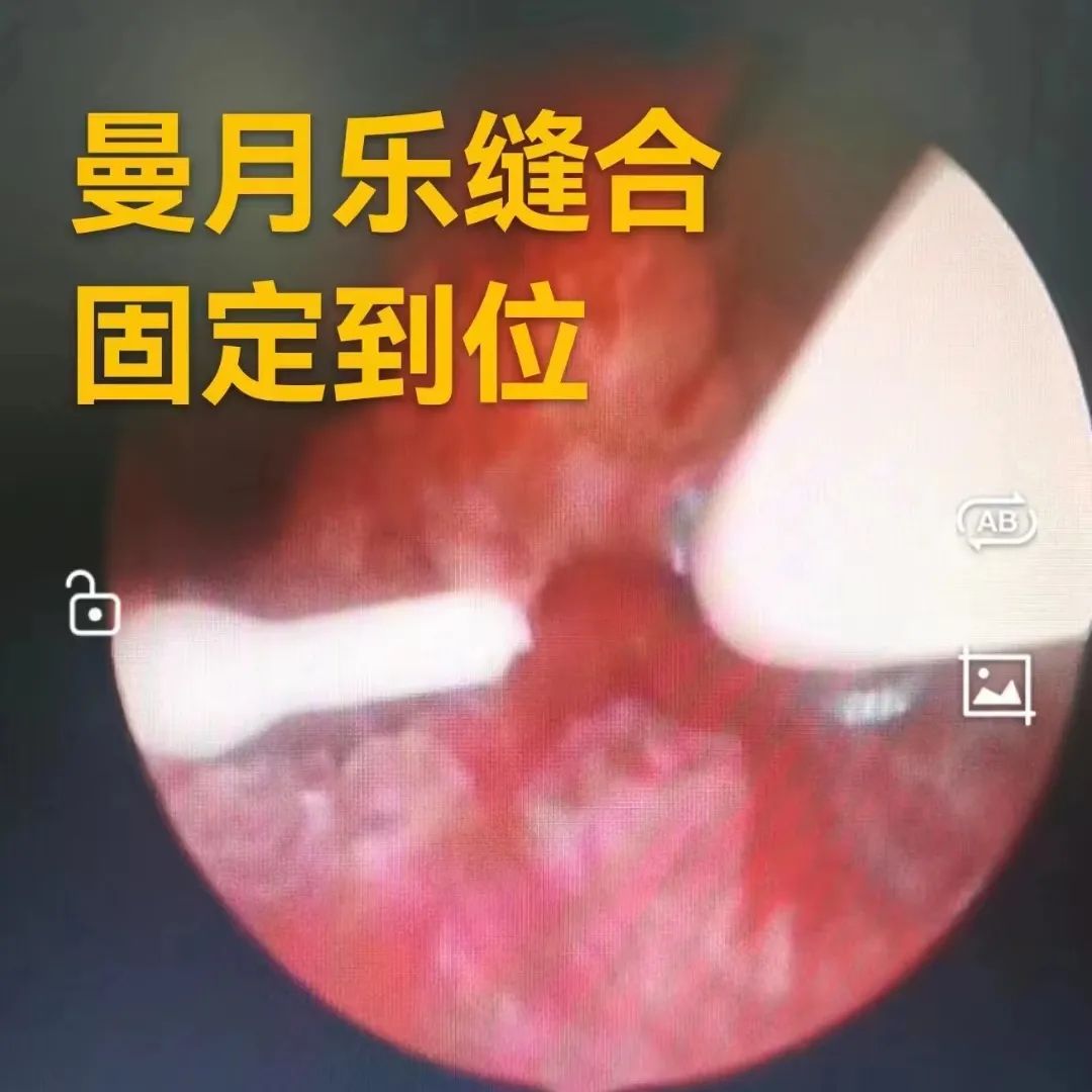 子宫腺肌症让子宫变大，“曼月乐”环也挂不住，咋办？