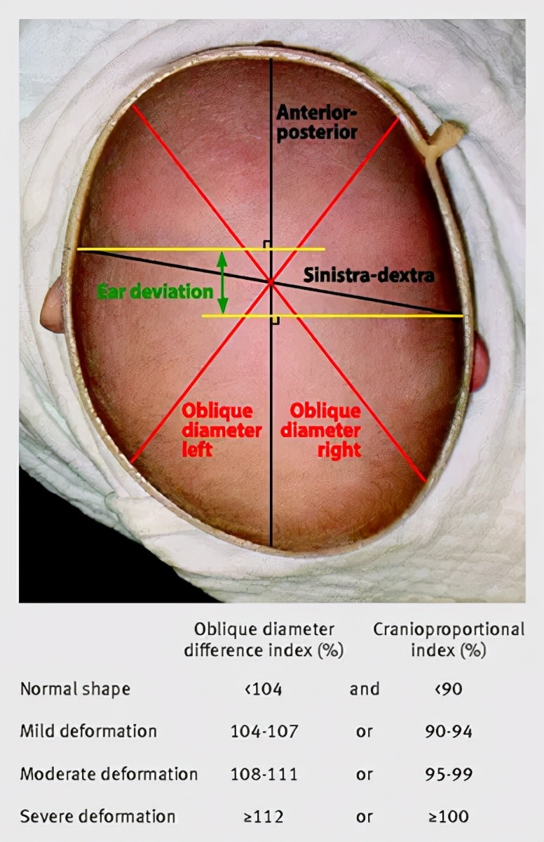 头型矫正头盔多长时间孩子能适应,宝宝一岁半能戴头盔矫正头型吗