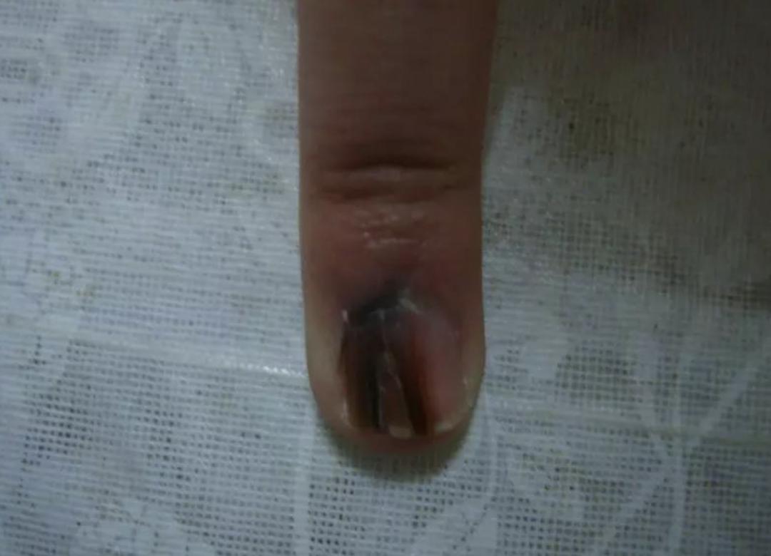 指甲上有黑线的预兆,指甲上有小黑线要注意哪些