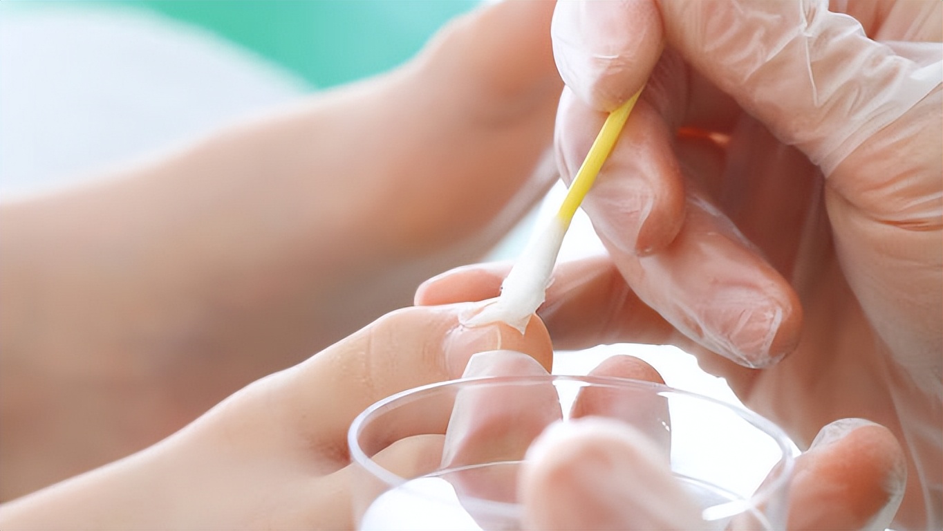 特比萘芬治灰指甲的方法,灰指甲吃特比萘芬多久能治愈