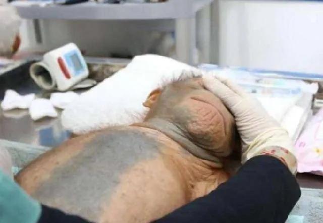 全球第一个换头成功的瘊子手术,首例换头的猴子