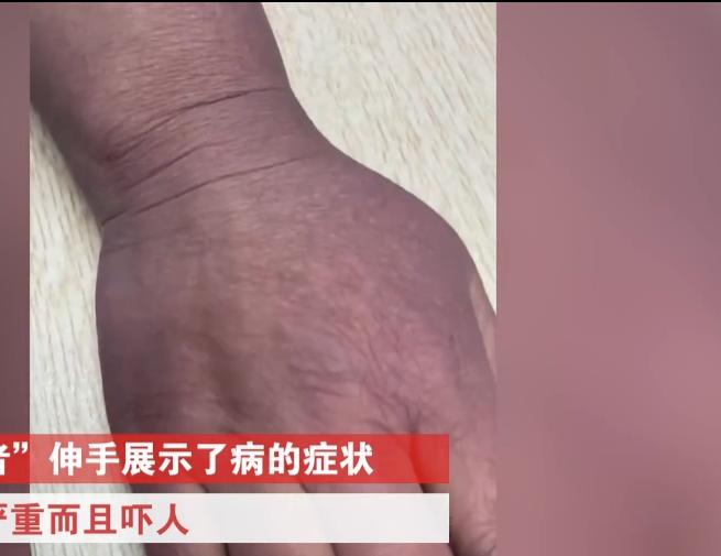 辽宁患者上肢发紫惊恐就医,女子上肢发紫惊恐就医