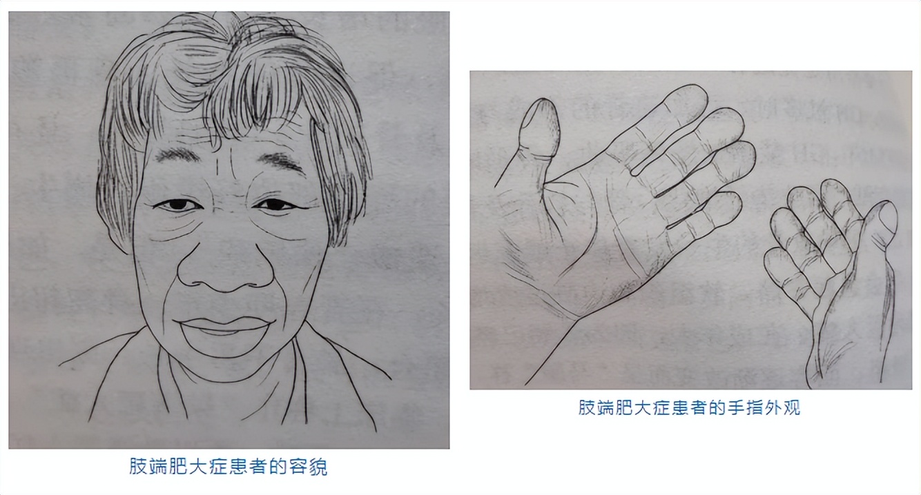 孩子身高突然长的很快怎么治疗,孩子身高长太快要警惕这种病