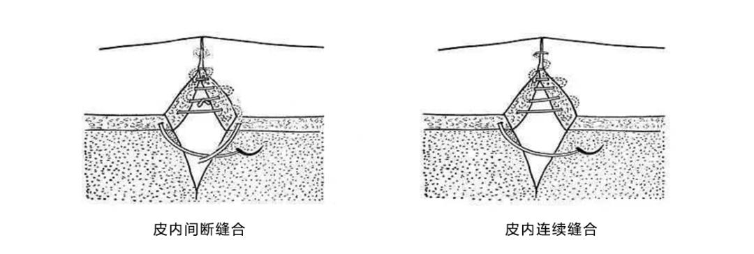 外科缝合技巧你熟练吗,外科缝合术的操作步骤