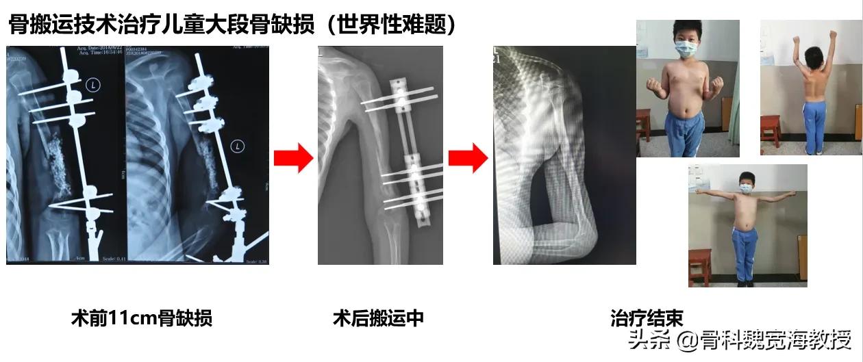 南方医院创伤骨科医生简介,南方医科大学深圳医院创伤骨科