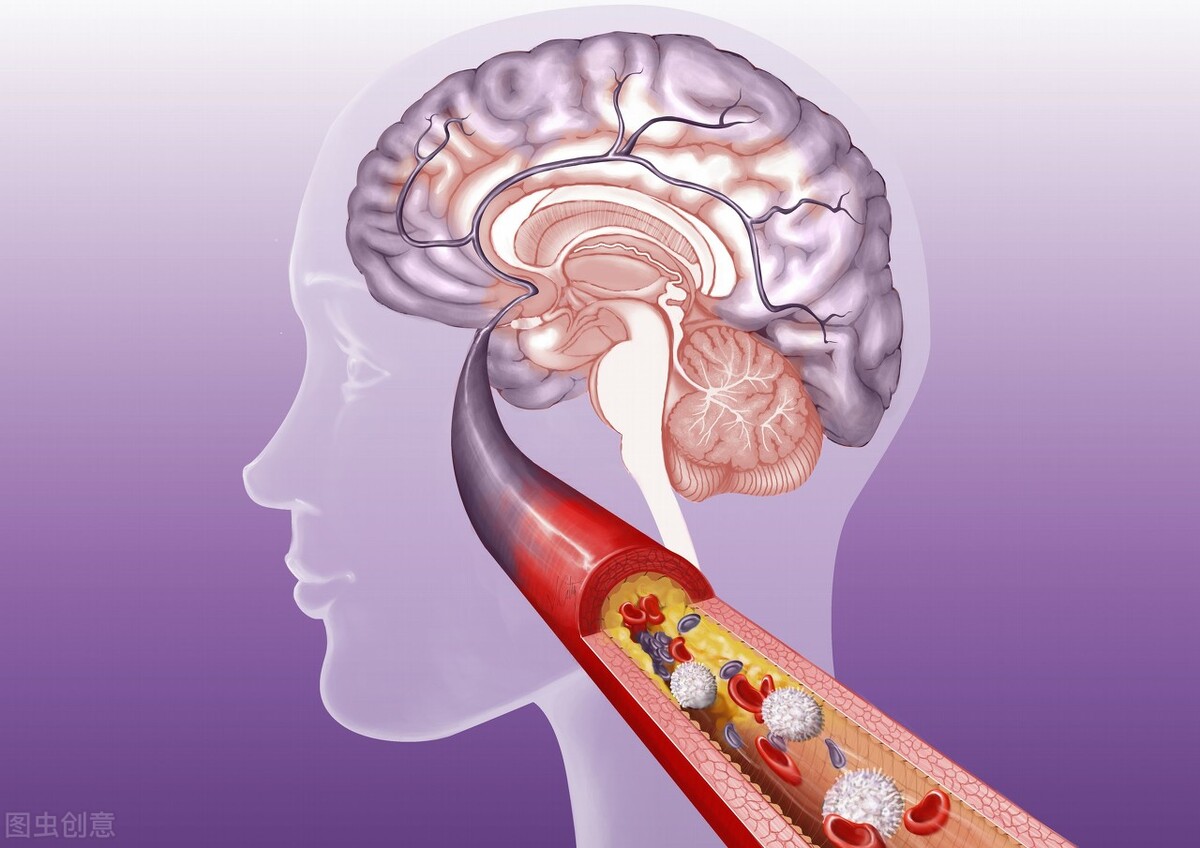 急性脑血管病的症状有什么,急性脑血管病会出现什么症状