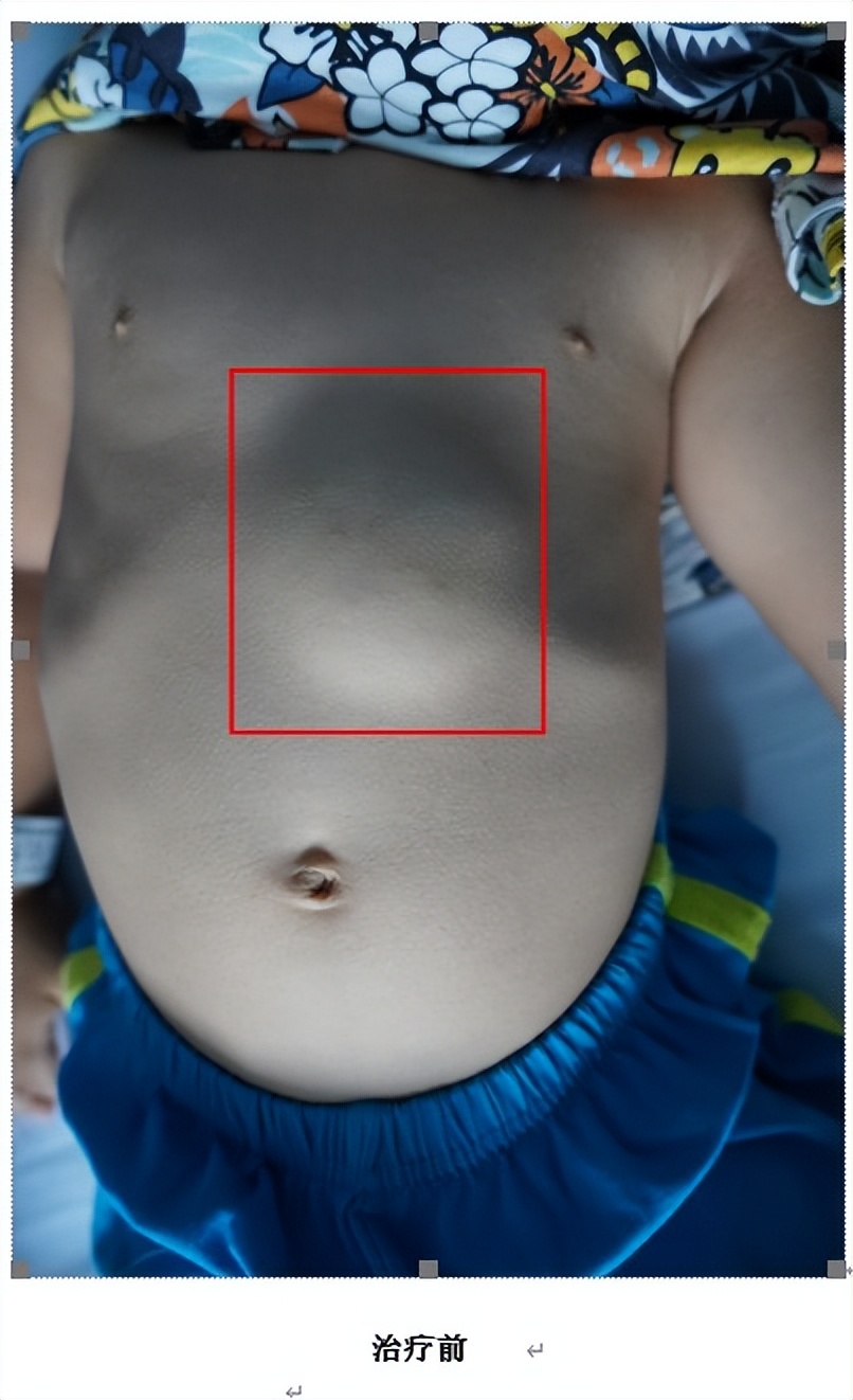 淋巴管瘤的微创治疗,淋巴管瘤微创介入手术第二天